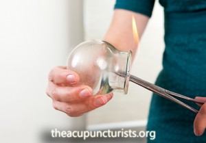 Chinese Cupping Therapy - Margate, Coral Springs, Coconut Creek Florida