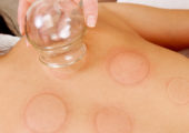 Cupping Therapy and Sciatica