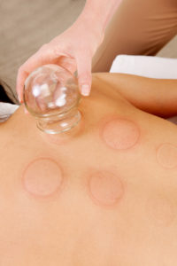 Cupping-and-Sciatic-Pain-in-Margate-South-Florida