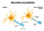 Acupuncture for Multiple Sclerosis
