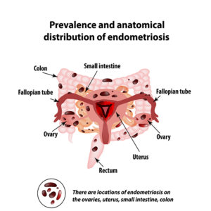 treating endometriosis naturally - South Florida