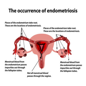 treating endometriosis with diet and nutrition in south florida