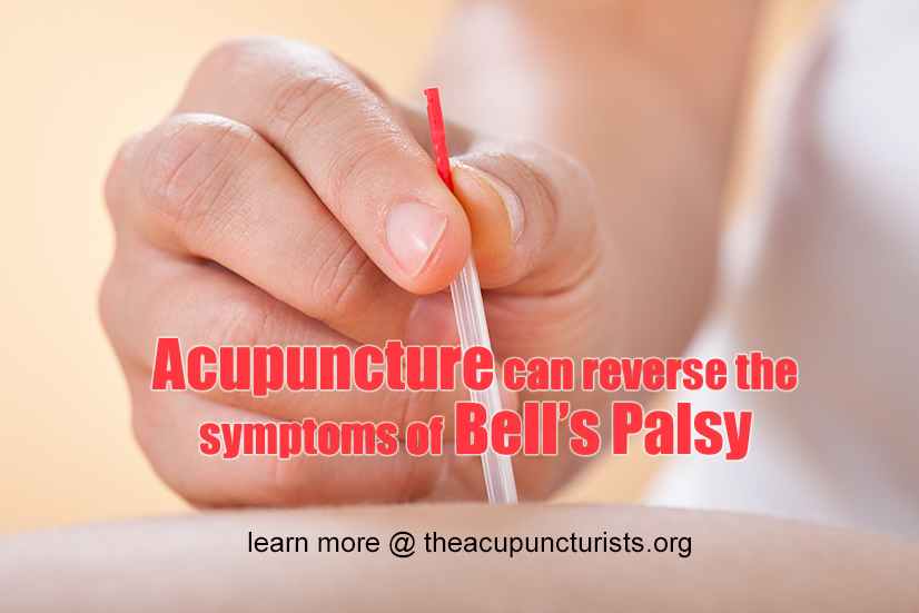 Acupuncture and Bell's Palsy - effective treatment in Margate Florida