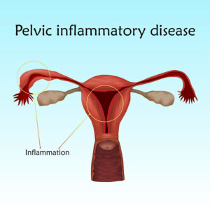 Natural-Treatment-for-PID-Pelvic-Inflammatory-Disease-in-Coral-Springs-Florida