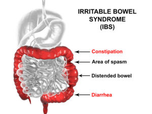 What is IBS, Irritable Bowel Syndrome - Margate, Florida