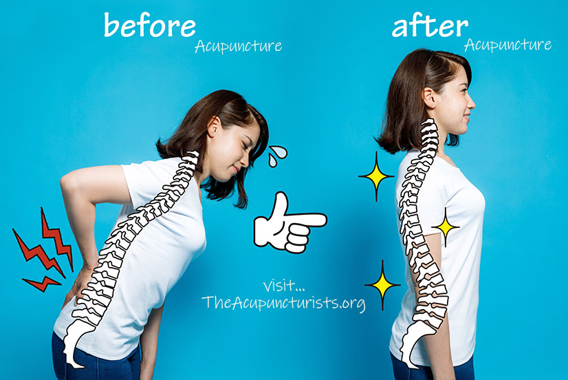 acupuncture for low back pain in coral springs and coconut creek Florida