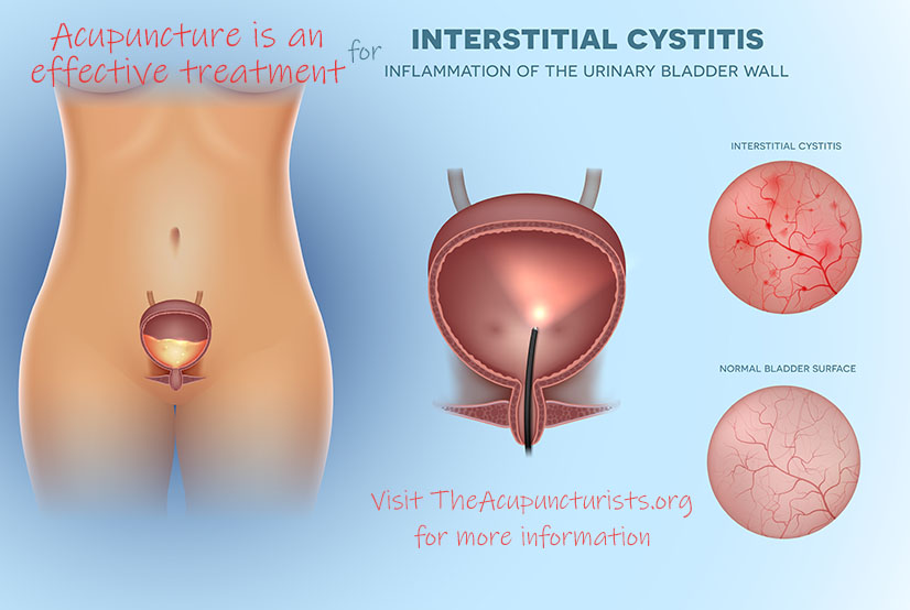 Acupuncture for Interstitial Cystitis in Margate, Coconut Creek, Coral Springs Florida